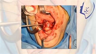 فیلم تومورهای بزاقی مینور