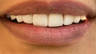 اصلاح طرح لبخند