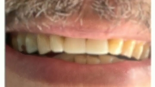 اصلاح طرح لبخند