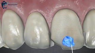 اصلاح طرح لبخند