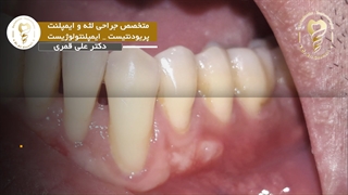 فیلم جراحی پیوند لثه 5 دندان فک پایین