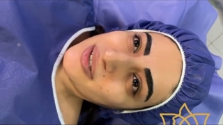 عمل زیبایی بینی قبل و بعد، رینوپلاستی