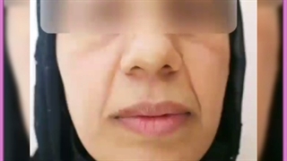 بهترین راهکارهای از بین بردن جای جوش و درمان آکنه