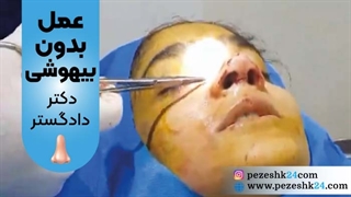 فیلم عمل بینی بدون بیهوشی