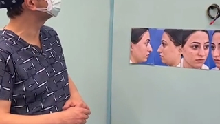 جراحی بینی نیمه فانتزی