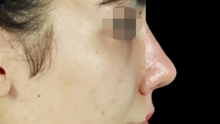 چهار ماه پس از جراحی بینی گوشتی و بزرگ