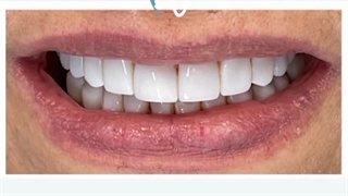 کامپوزیت دو فک