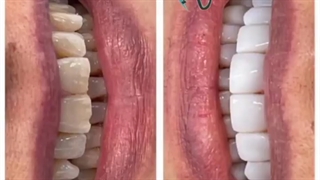 طبیعی بودن رنگ کامپوزیت