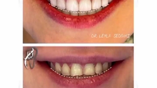 Smile design by composite veneers
