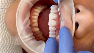 امتحان تطابق لمینیت ها و نحوه قرارگیری آن ها