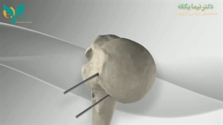 تعویض مفصل شانه