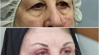 بلفاروپلاستی