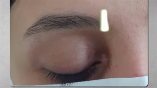 نمونه ای دیگر از پیوند مو به ابرو