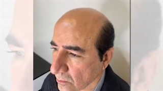 خاص ترین کاشت مو ایران