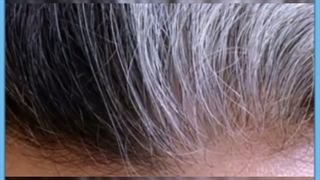 علل سفید شدن موها و راهکارهایی برای درمان