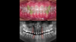 ارتودنسی نیش های نهفته | دکتر داودیان