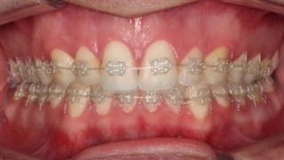 ارتودنسی بدون کشیدن دندان | دکتر داودیان