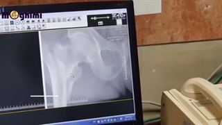 عمل جراحی شکستگی سر استخوان ران در بیمار ۹۶ ساله