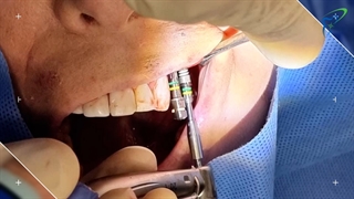 جراحی واقعی ایمپلنت