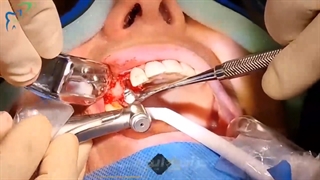 فیلم واقعی ایمپلنت دندان