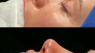 نمونه کار جراحی بینی دکتر سهراب مرادی