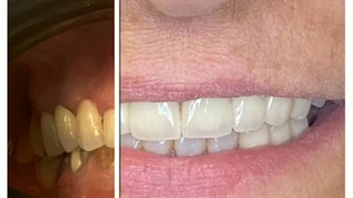 اصلاح طرح لبخند