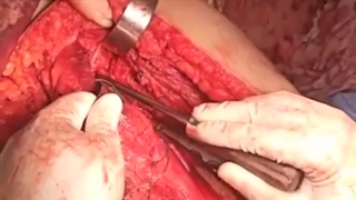 فیلم خارج سازی تومور پای پسر 14 ساله