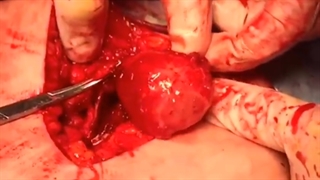 خارج سازی تومور از کنار شریانی