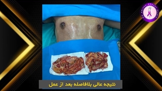 فیلم قبل و بعد عمل ژنیکوماستی