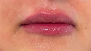 تزریق فیلر کربوکسی تراپی