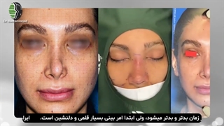 عمل ترمیمی بینی با استفاده از غضروف دنده و فاشیای رکتوس