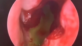 نشت مایع مغزی نخاعی به دلیل تصادف و ترمیم به روش دکتر خوش سیرت