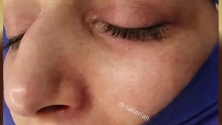 جراحی زیبایی بینی با سوراخ های بزرگ