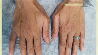 تزریق چربی به دست و نانوفت