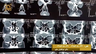 خارج کردن تومور چشمی