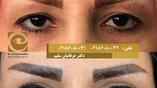 نتیجه جراحی بلفاروپلاستی دو پلک بالا