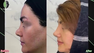 جراحی بینی ترمیمی با استفاده از غضروف دنده | دکتر باستانی نژاد