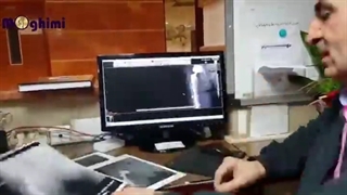 عمل جراحی شکستگی پری پروستتیک فمور در بیمار ۹۳ ساله