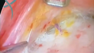 لیفت آندوسکوپی پیشانی