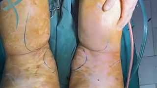 لیپوماتیک ساق ران