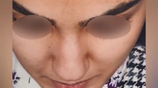 فیلم واقعی جراحی زیبایی بینی