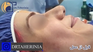 فیلم واقعی جراحی بینی گوشتی در اتاق عمل