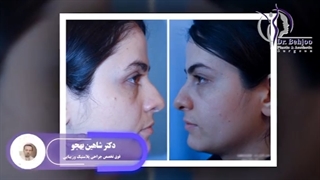 رینوپلاستی و اصلاح انحراف بینی
