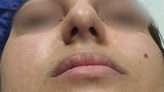 نمونه های جراحی بینی دکتر علی طاهری نیا
