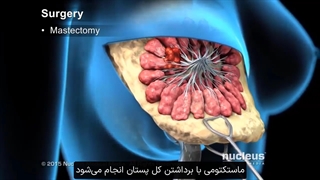 درمان سرطان سینه | شناخت روش‌های درمانی سرطان سینه