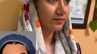 ویدیو نتیجه عمل بینی گوشتی توسط دکتر سعید شیرنگی