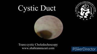 کلدوکوسکوپی از طریق مجرای کیسه صفرا