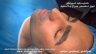 جراحی بینی طبیعی مردانه