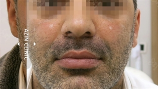 زاویه سازی صورت برای آقایان