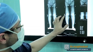 فیلم جراحی تعویض مفصل هر دو زانو